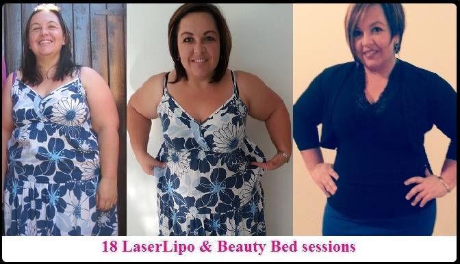 Lipo Cavitation & RF is - Skin & Laser Clinic Newcastle