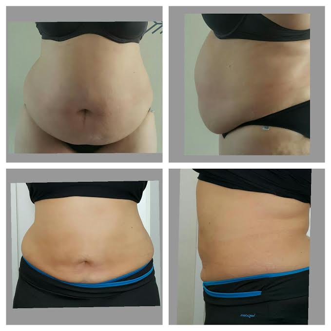 What is the cost of lipo injections in South Africa?